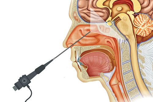 Example of Minimally Invasive Surgery | Carolina Neurosurgery & Spine Associates