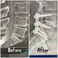 befor after spine befor after spine