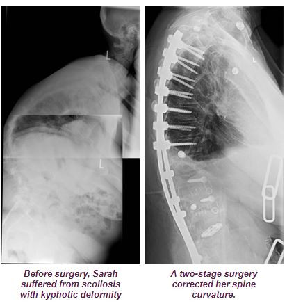 Before and After Surgery Before and After Surgery