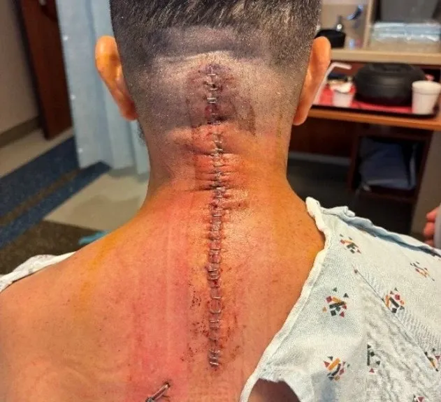 Image of Rafael's surgical wound showing a long incision with staples along the back of his neck