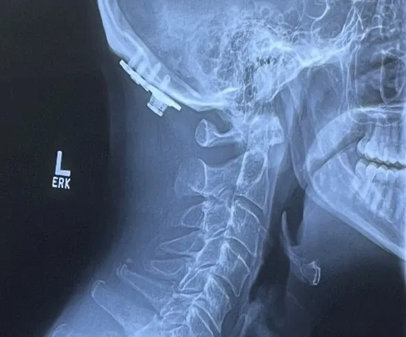 An x-ray image of Rafael's neck and skull